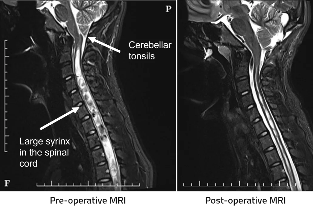 Case Study 1 – Chiari and Syrinx