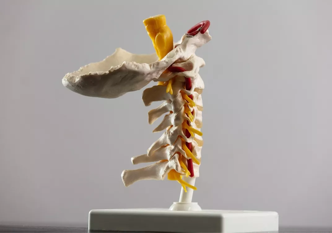 Cervical Disc Protrusions professor brian owler