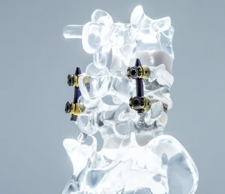 Spondylolisthesis Treatment in Sydney