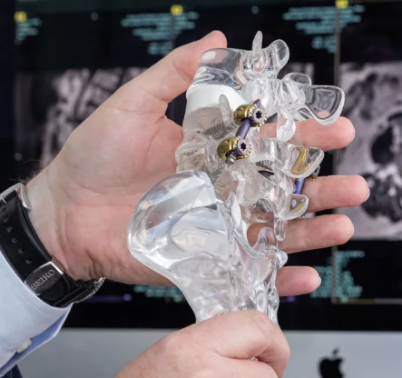 What is an extreme lateral lumbar interbody fusion or XLIF